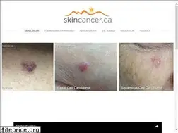 Sites similar to skincancer.ca