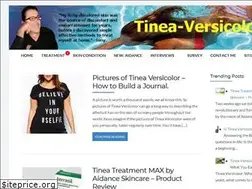 Sites similar to tinea-versicolor.net